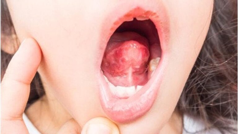 Granulomas linguales: s&iacute;ntomas, causas y tratamiento