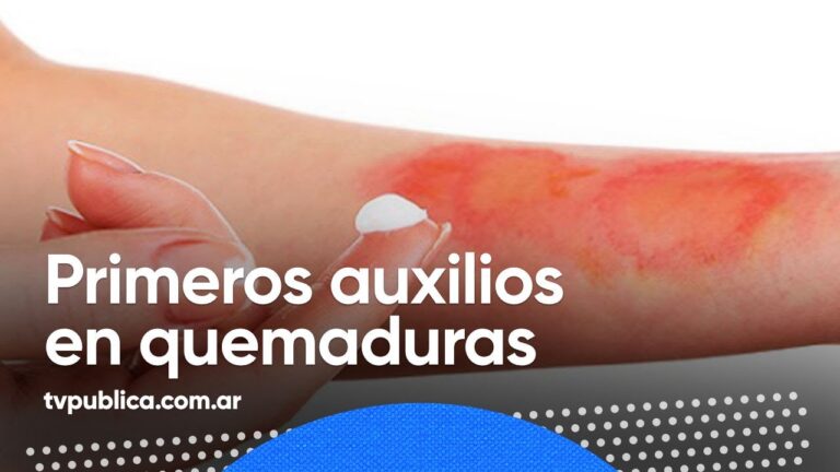 Cómo aliviar el ardor de una quemadura en la mano